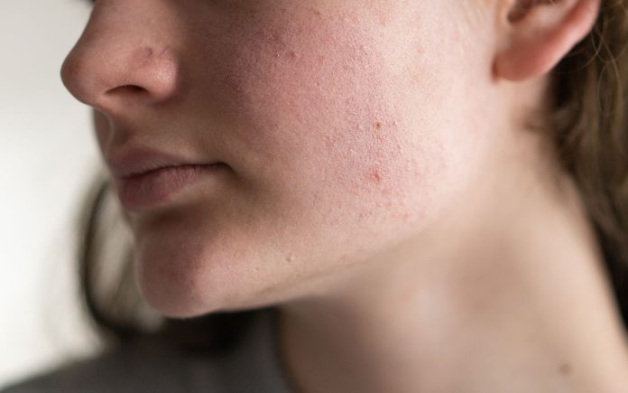 kulit kurang terhidrasi